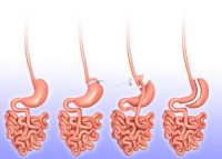 Surgery Should Be An Option for Diabetics: Experts