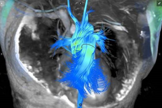 Arterys, GE Healthcare to Roll Out Next-Gen MRI Scans of Heart