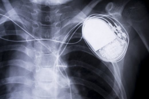 Man’s pacemaker data leads to arson and insurance fraud charges