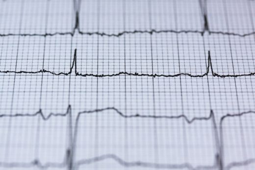 AI identifies ‘invisible’ heart condition LQTS