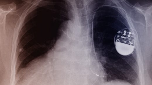 Hearstopping security news: Hackers can now get into pacemakers