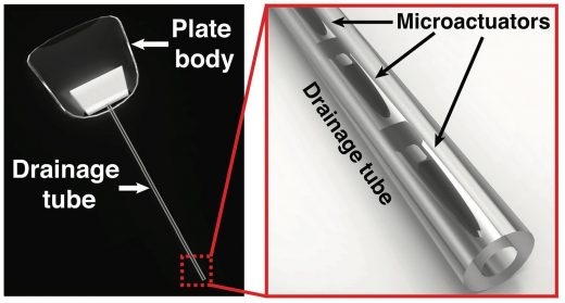 Magnetic eye implants could save the eyesight of glaucoma patients