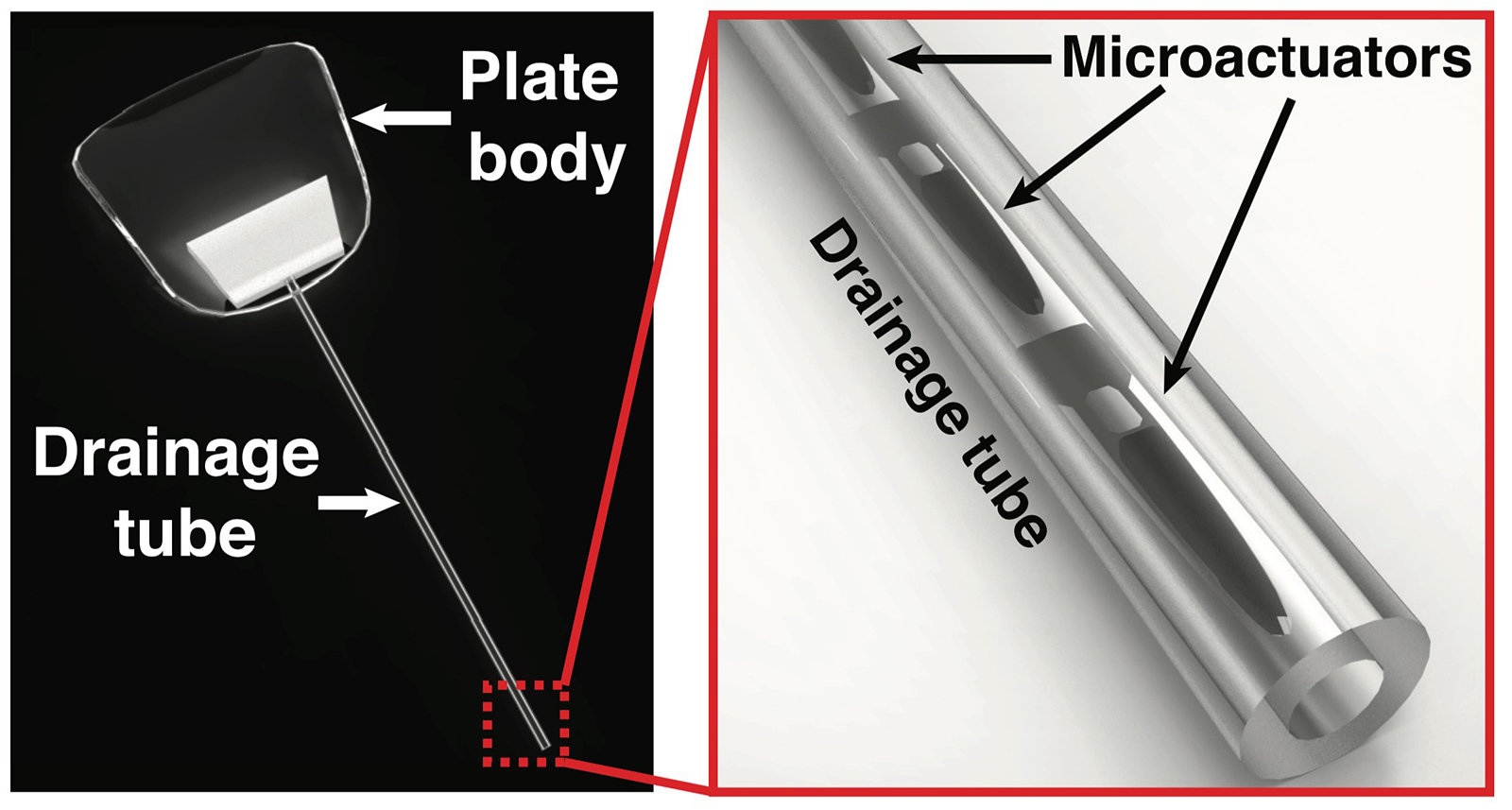 Magnetic eye implants could save the eyesight of glaucoma patients | DeviceDaily.com