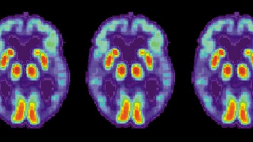 Artificial intelligence can detect Alzheimer’s in brain scans six years before a diagnosis
