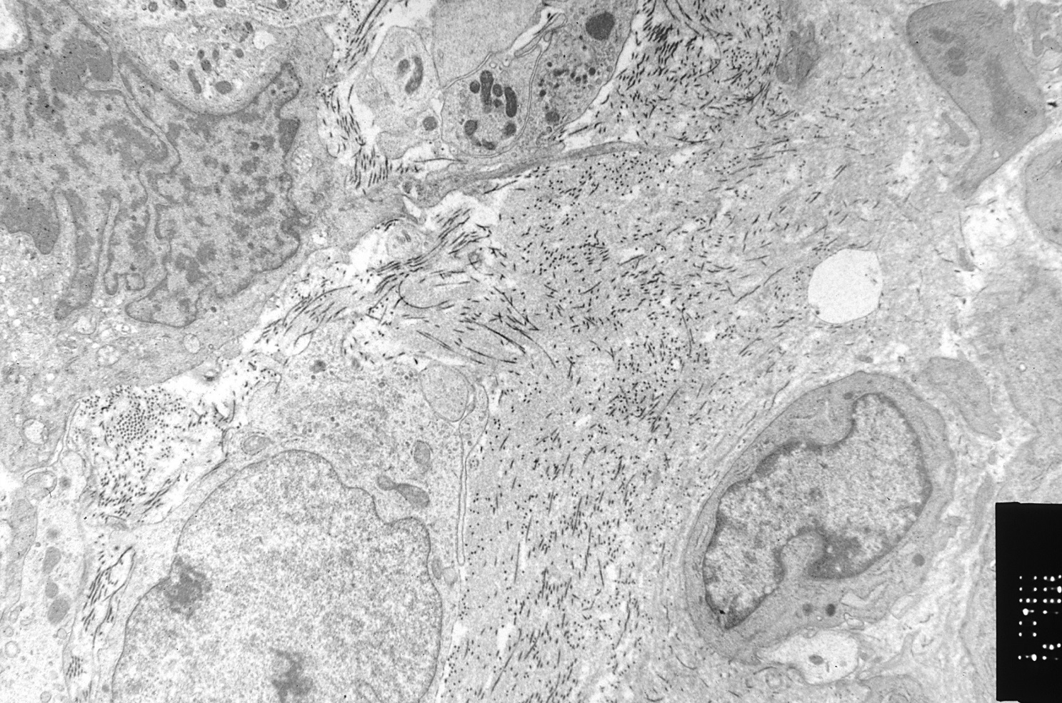 Failed Clinical Trial Puts Eli Lilly Cancer Drug in Limbo | DeviceDaily.com Failed Clinical Trial Puts Eli Lilly Cancer Drug in Limbo | DeviceDaily.com