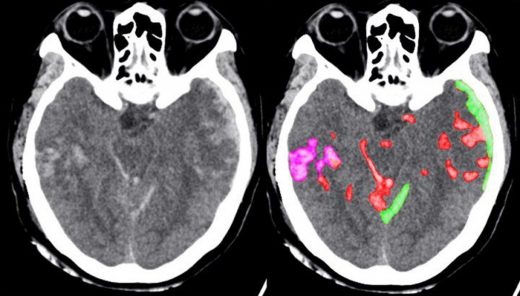 AI can help doctors spot brain hemorrhages faster