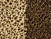 Amgen’s Osteoporosis Drug Wins European Nod, With a Heart Warning