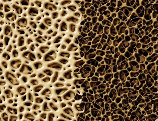 Amgen’s Osteoporosis Drug Wins European Nod, With a Heart Warning