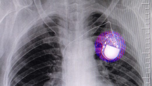 Apple’s wireless charging tech may interfere with pacemakers